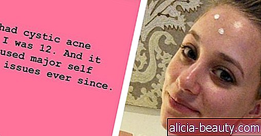 Lili Reinhart taler om hendes usikkerhed med cystisk acne på den rigtige måde