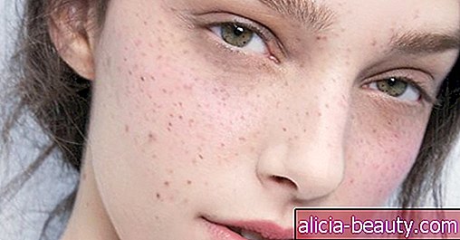 Dermatologists מסכים: אלה 6 תנאים נפוצים עור לא ניתן לרפא
